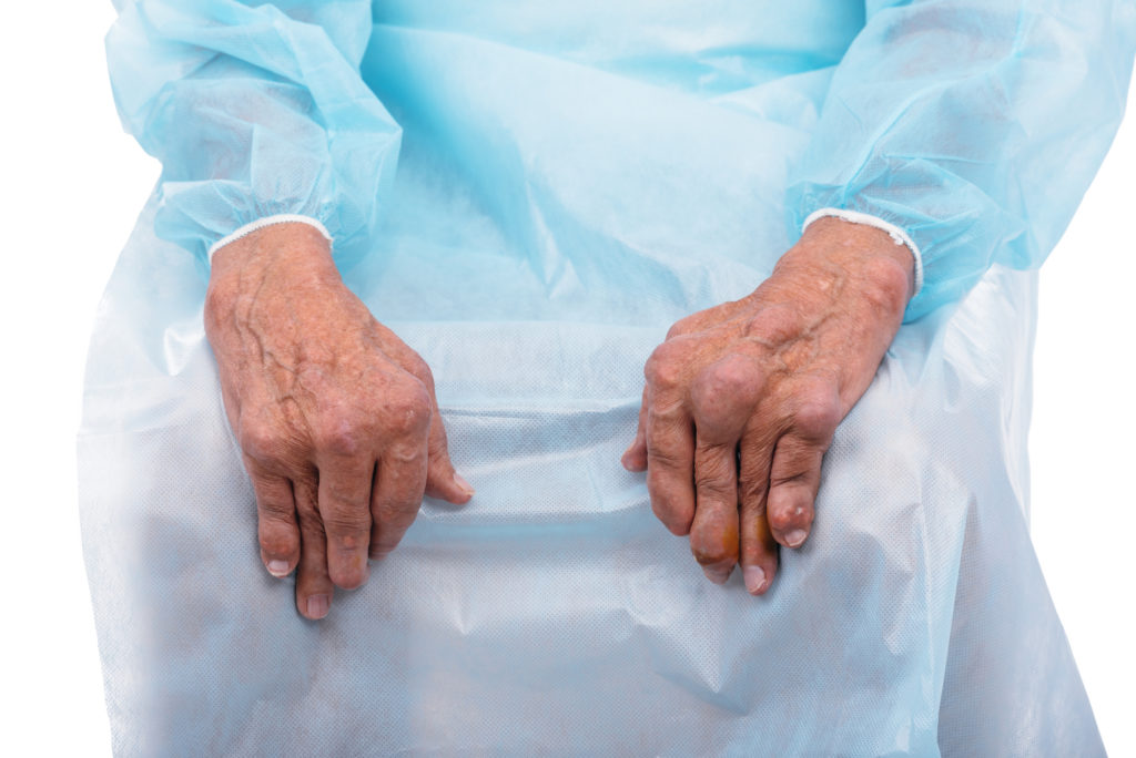 Älterer Mann mit chronischer, stark entwickelter Polyarthritis in den Händen